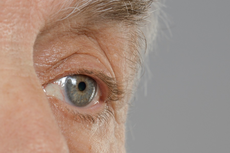 cataracts